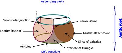 3D Fluid-Structure Interaction Simulation of Aortic Valves Using a Unified Continuum ALE FEM Model